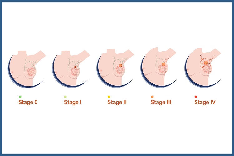 مرحله بندی سرطان سینه و میزان پیشرفت سرطان در هر مرحله