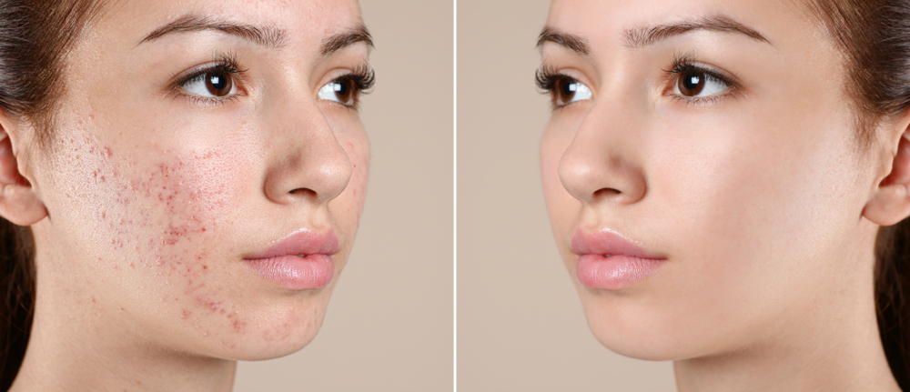 درمان جای جوش صورت با لیزر، بهبودی در کمترین زمان