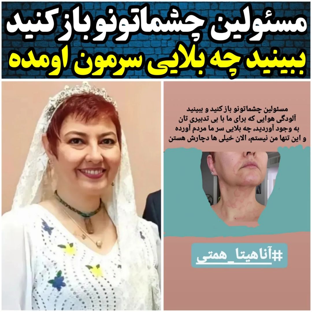 بیماری پوستی آناهیتا همتی که با آلودگی هوا عود کرد