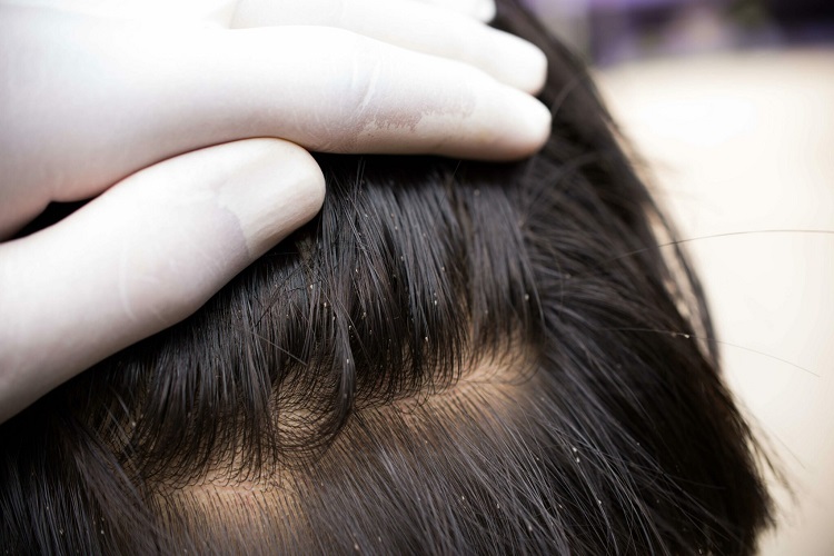 How-to-Recognize-and-Treat-Head-Lice-scaled-1