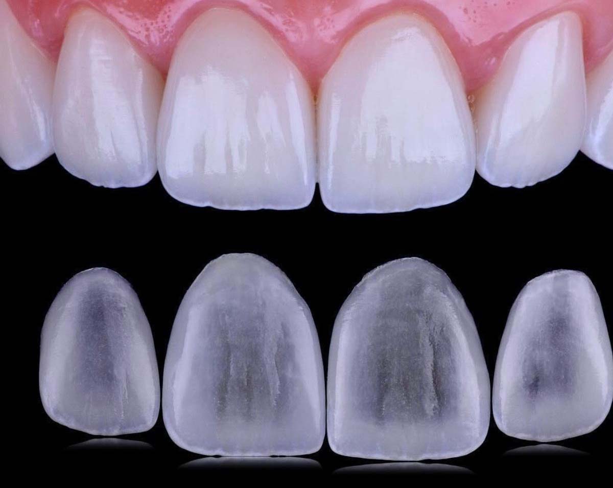 Dental laminate