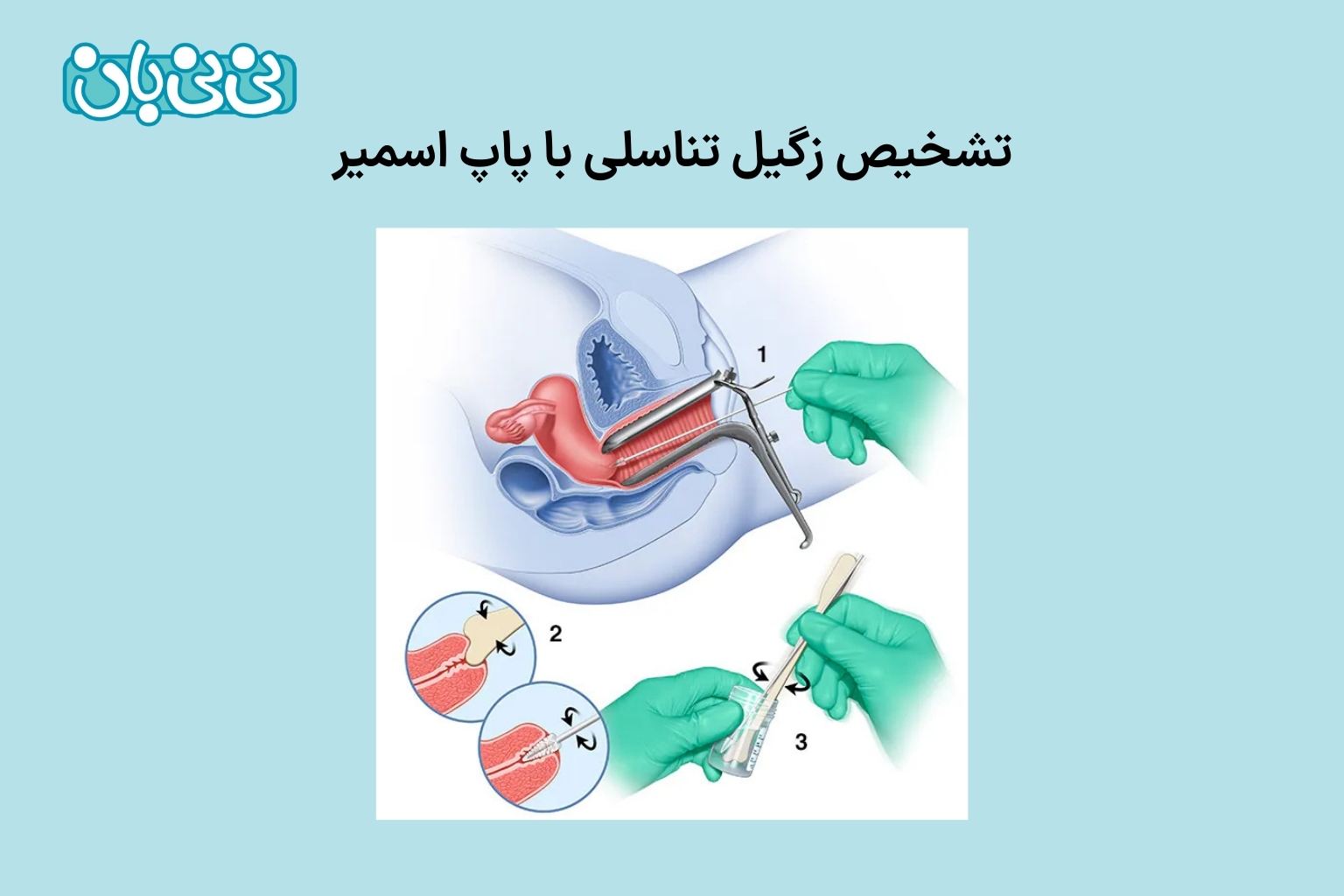 تشخیص زگیل تناسلی با پاپ اسمیر