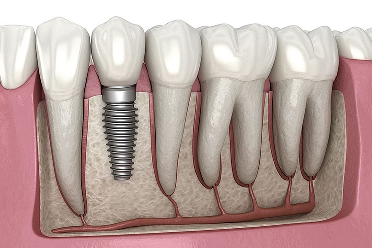 Dental-implant-steps