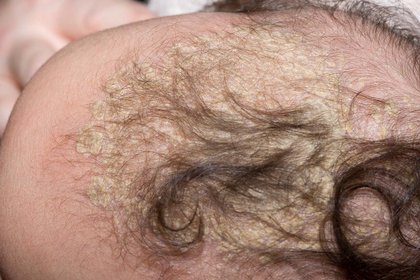 S_0219_Cradle_cap_C0194113.2e16d0ba.fill-420x280