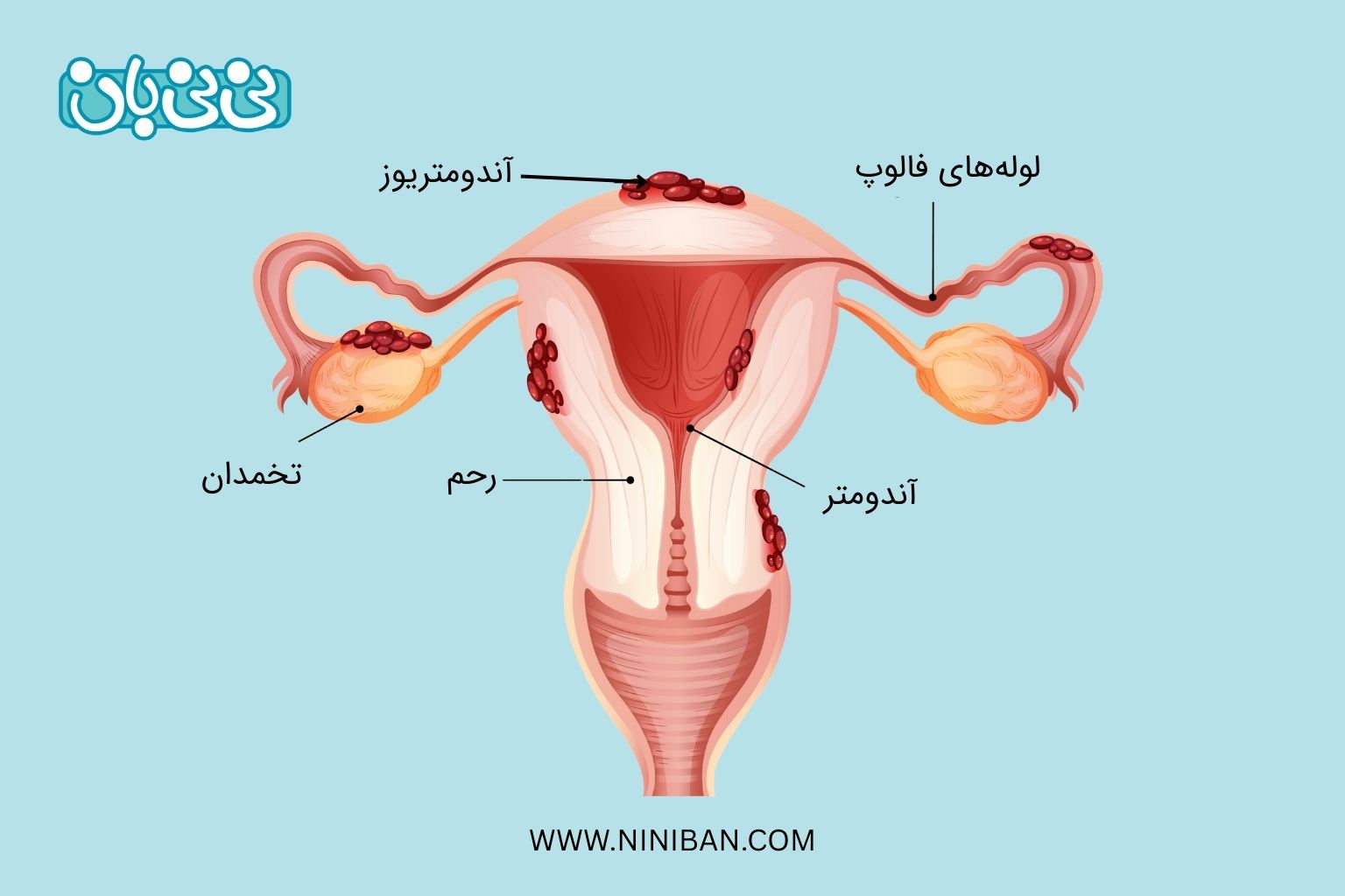 آندومتریوز چیست؟