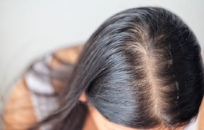 ریزش موی هورمونی در خانم ها/ اختلالات تیروئید