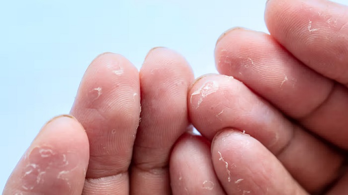 علت پوسته شدن کف دست: آیا ربطی به قاعدگی دارد؟