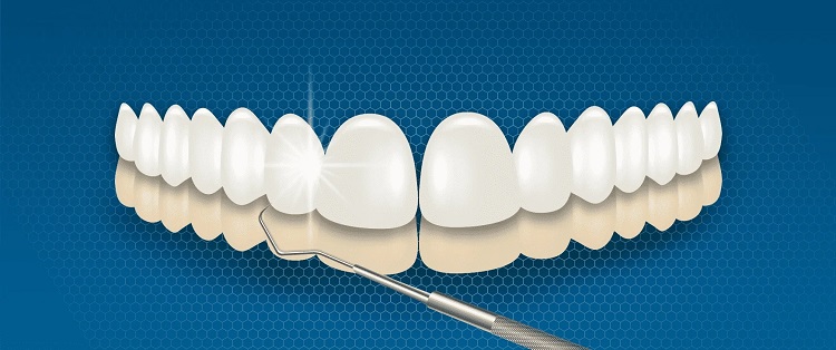 لمینت دندان بدون تراش چه مزایا و معایبی دارد؟
