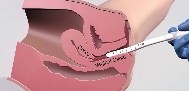 هزینه عمل تنگی واژن چقدر است؟ 