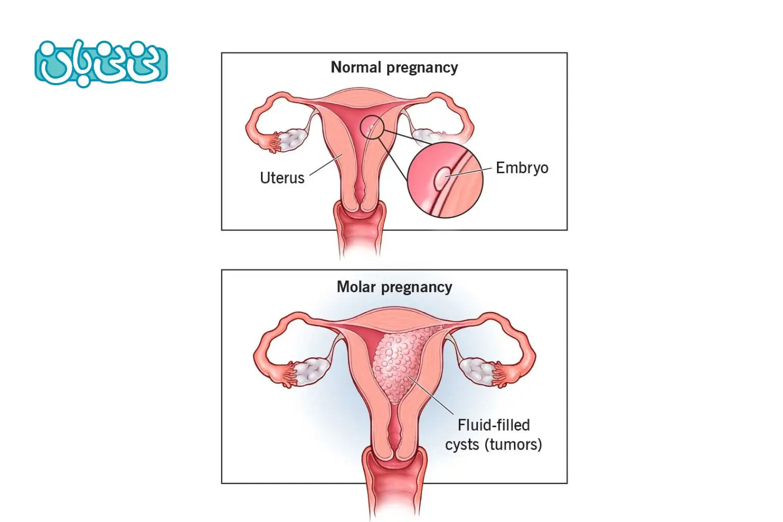 بارداری پوچ چیست