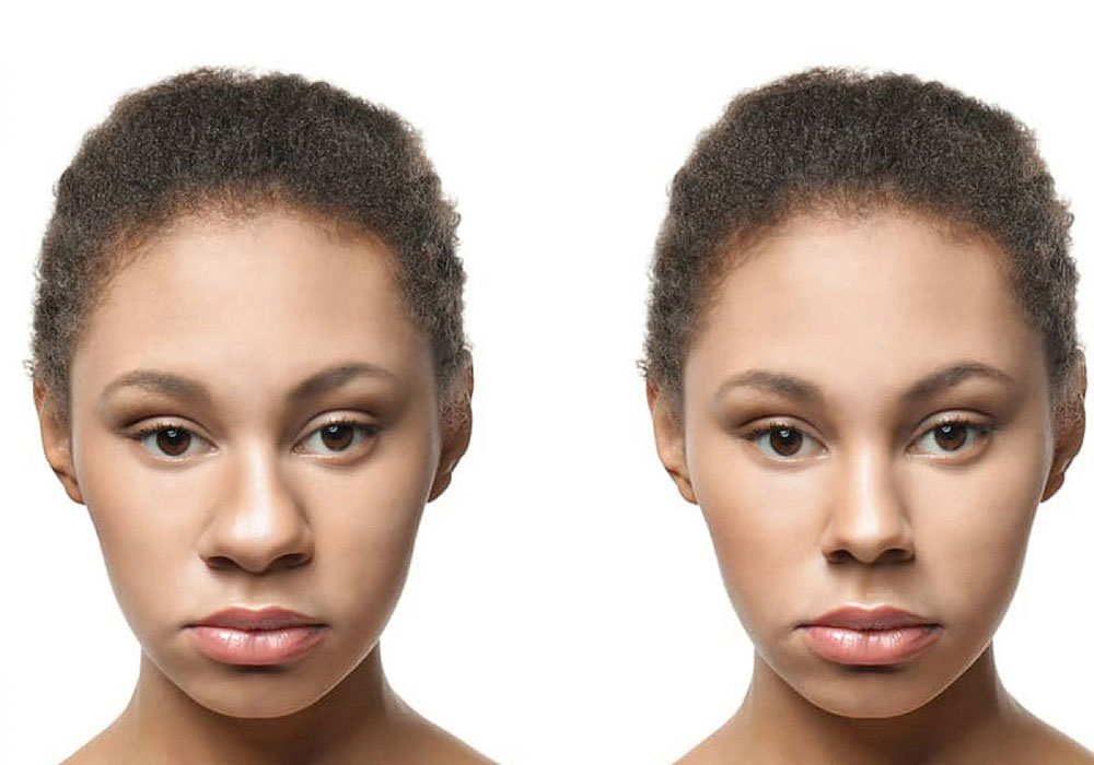 Nose-surgery
