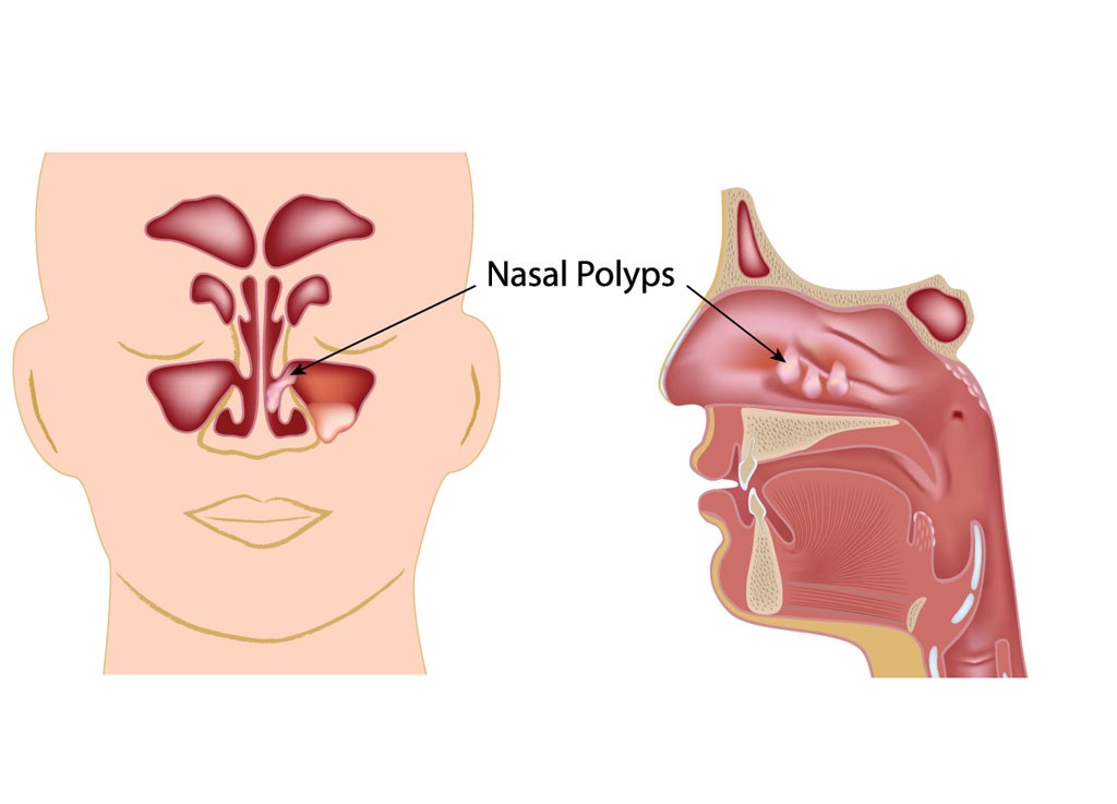 nasal-polyps-1024x737