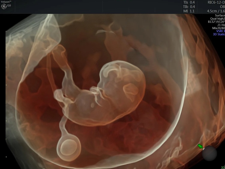 X0000_GE_Volusion E10 ultrasound fetal 3D 4D image_1