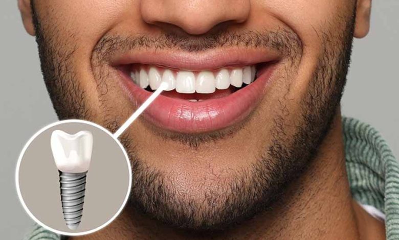 1688209296-dental-implant-placement-drhamidrezahamedi-780x470