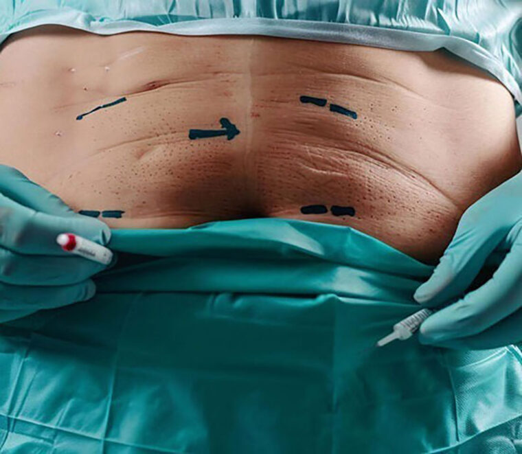 surgeon-wearing-surgical-gloves-marking-up-overweight-male-patient-with-black-marker_661495-69044-550x478-1-e1747358369449