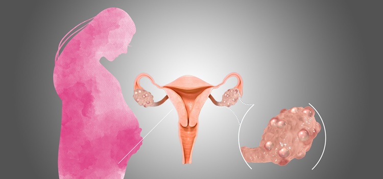 polycystic-ovarian-syndrome-and-pregnancy21