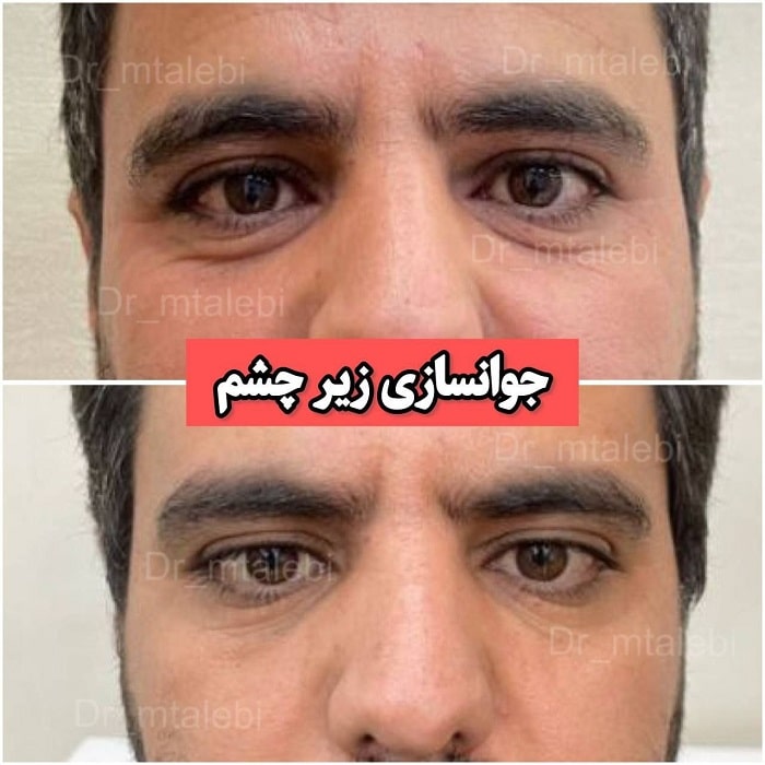 تزریق اگزوزوم