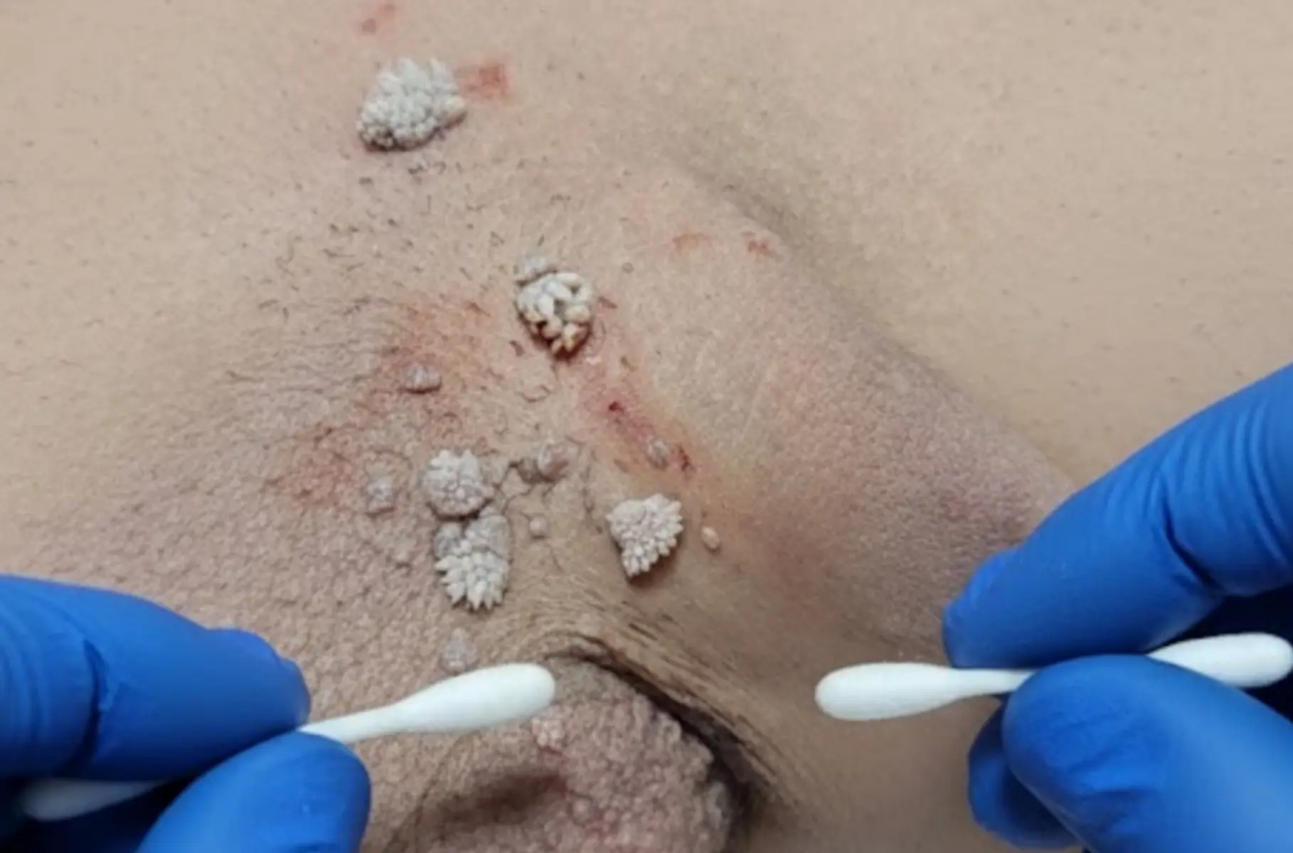 علائم اچ پی وی