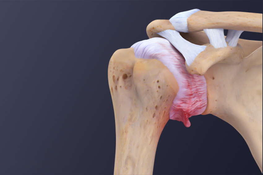 Adult-Shoulder-Joint-frozen-shoulder
