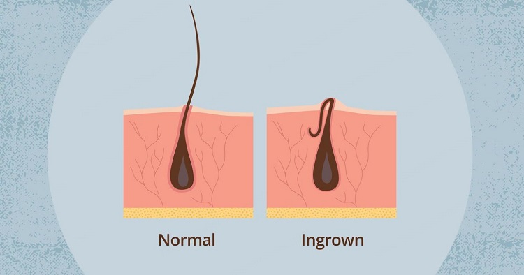 Ingrown-Hair-Causes-Treatment