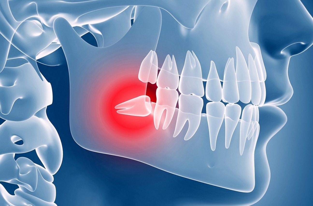 دندان عقل نیمه نهفته چه عوارضی دارد؟
