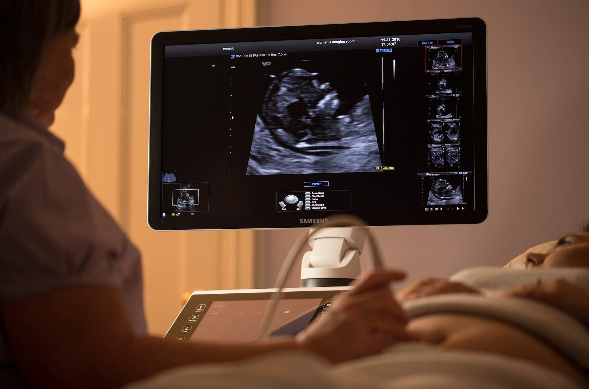 fetal-ultrasound-gender-determination-min