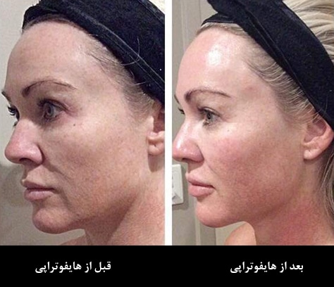 اثرات هایفوتراپی