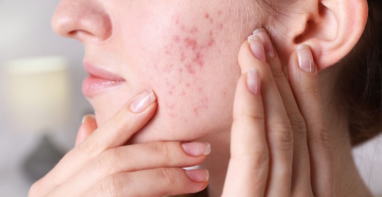 hormonal-acne1