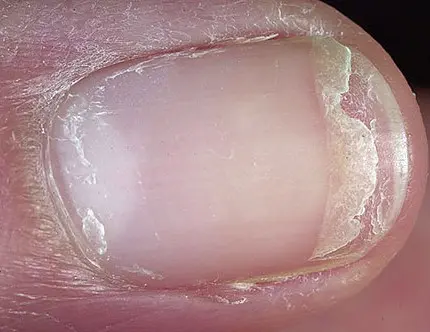 علل شکنندگی ناخن 