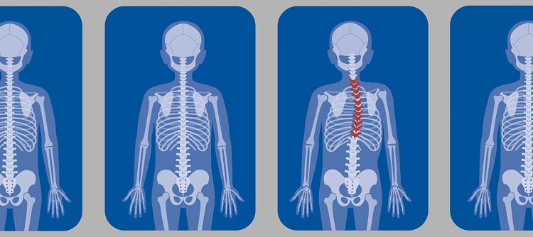 درمان اسکولیوز کودکان، مداخله پزشکی نیاز است؟