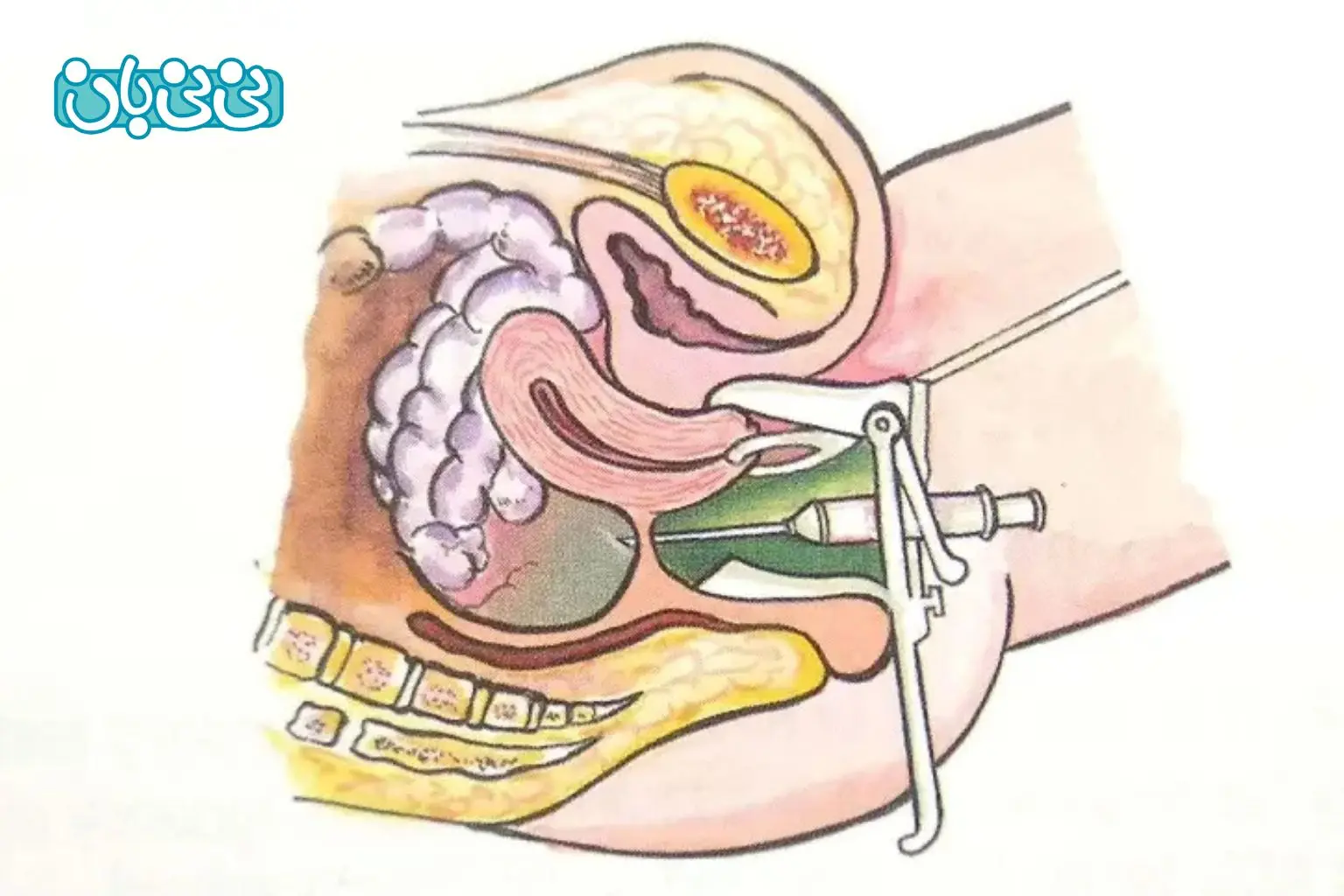 کولدوسنتز چیست (1)