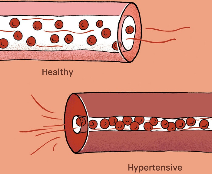 علائم فشار خون بالا یا هایپرتنشن چیست؟