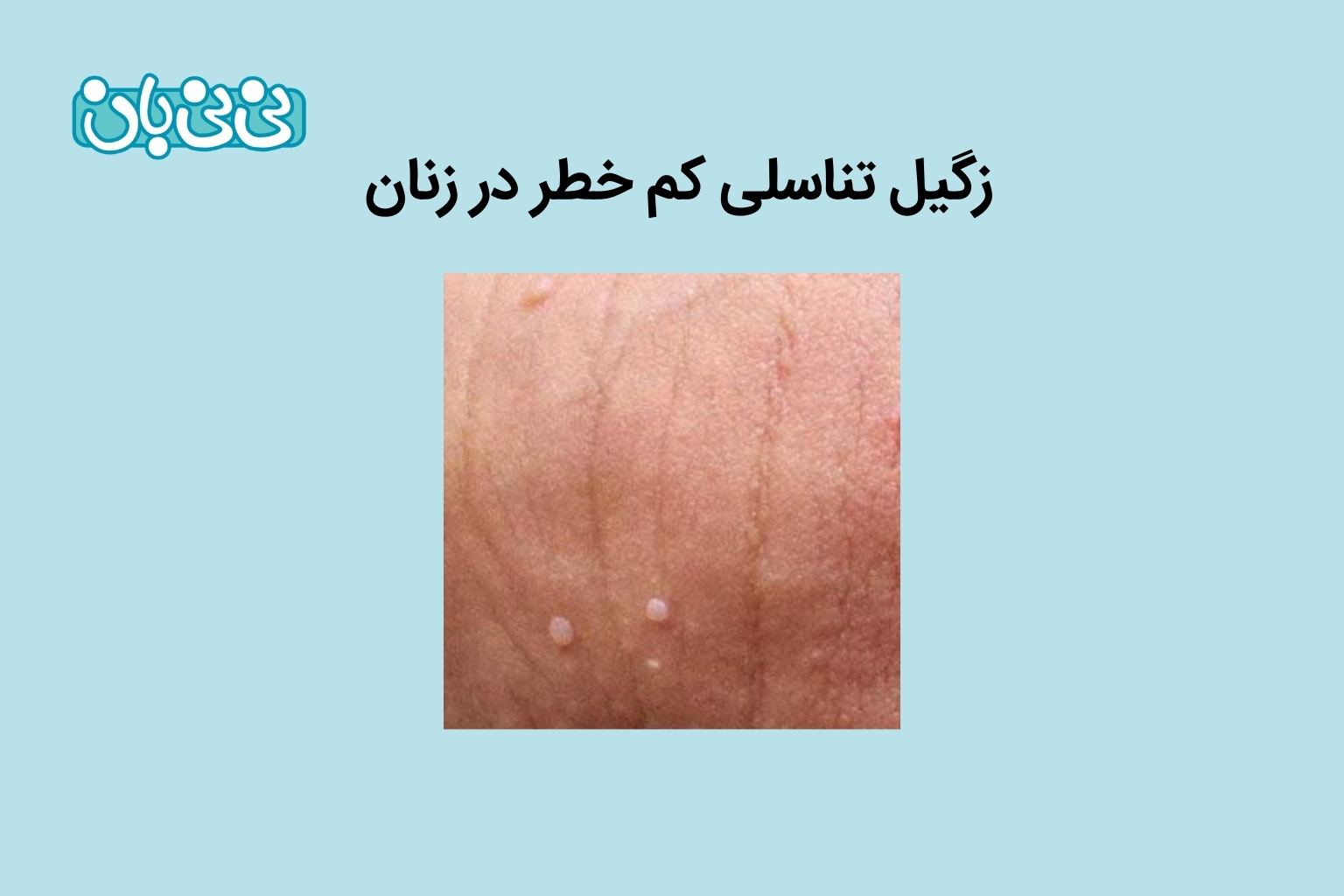 عکس زگیل تناسلی کم خطر در زنان