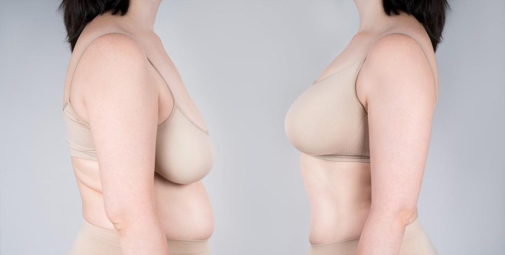 breast-lift-1024x517-1