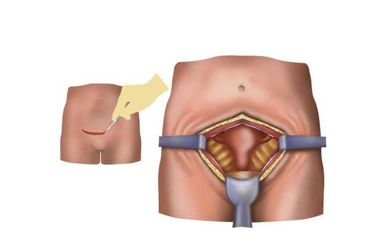 open-abdominal-myomectomy