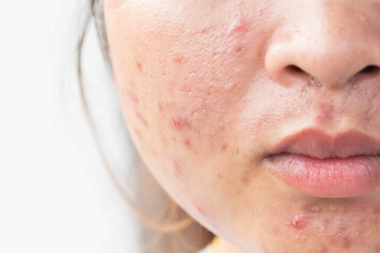 بهترین روش درمان اسکار صورت برای خانم ها
