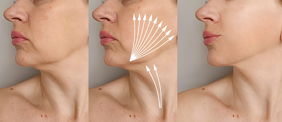 خارج سازی نخ‌های لیفت عفونت کرده چگونه انجام می‌شود؟