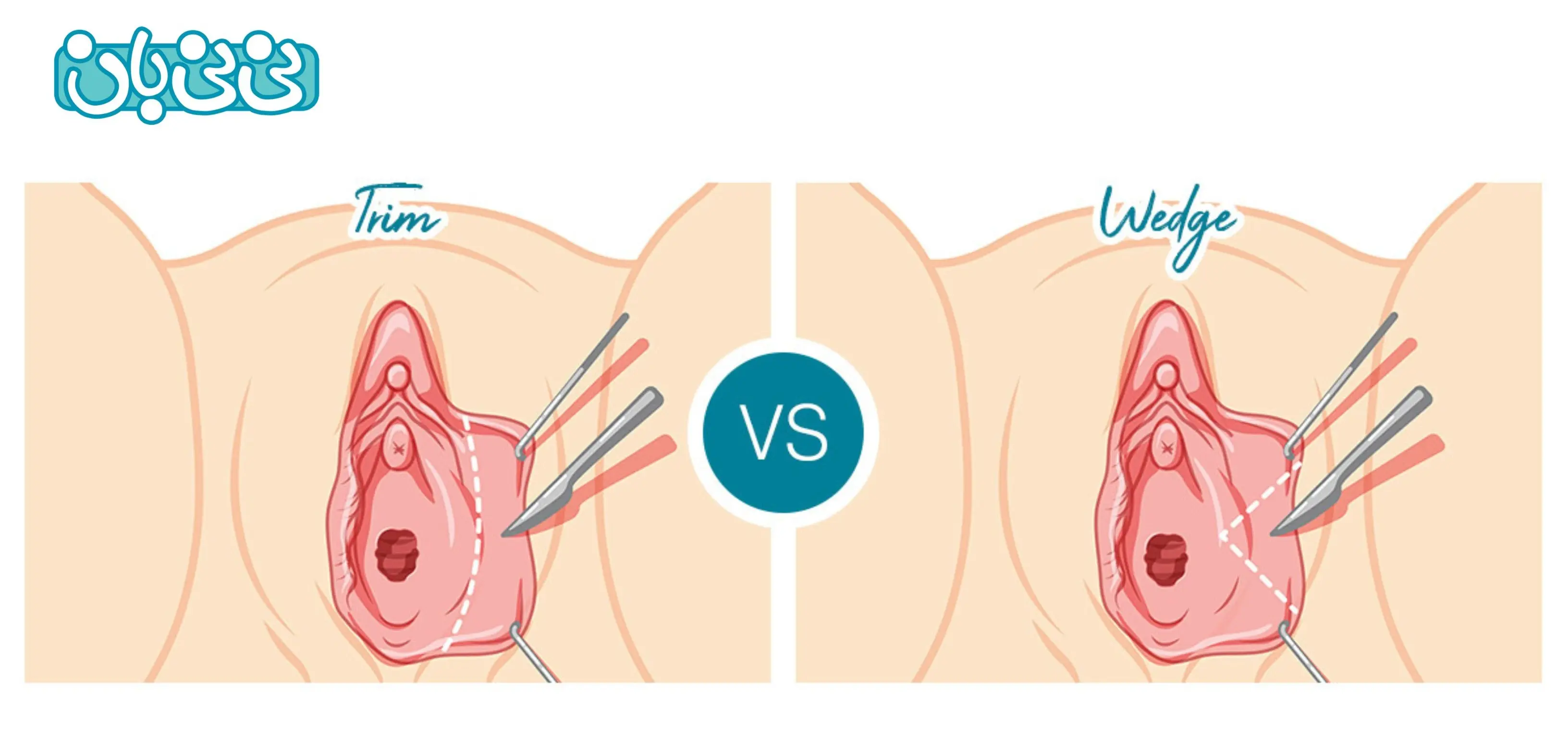 روش‌های عمل لابیاپلاستی چگونه است