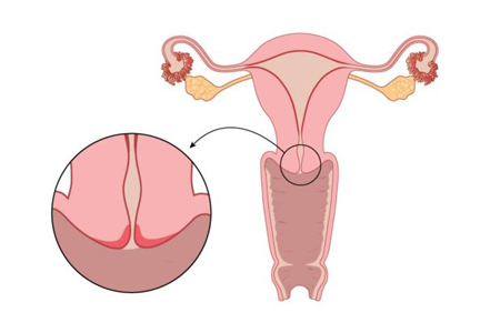 symptoms-cervical1-2