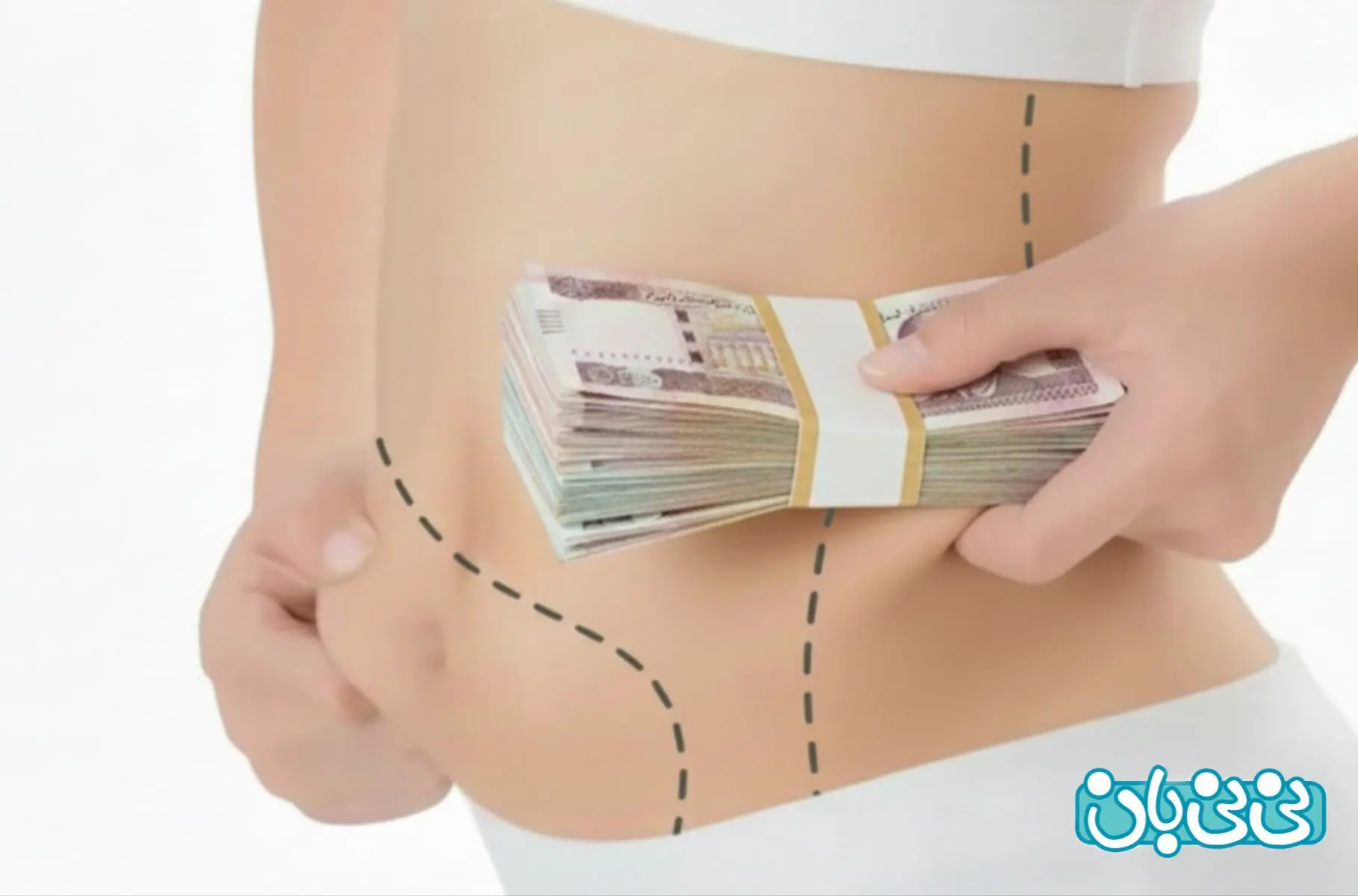 قیمت عمل آبدومینوپلاستی