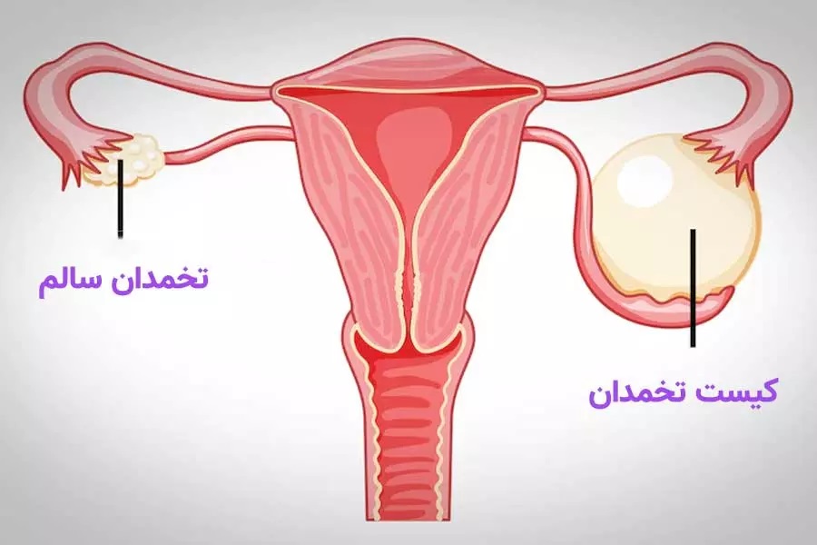 تنبلی تخمدان