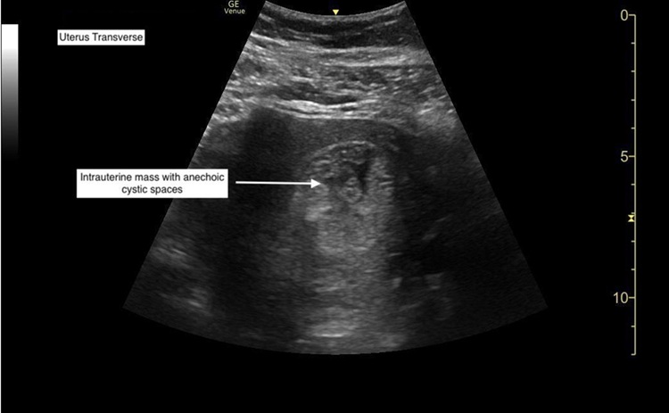 Point-of-Care-Ultrasound-to-Diagnose-Molar-Pregnancy.-A-Case-Report.-US-Annotated-still.-JETem-2022-11