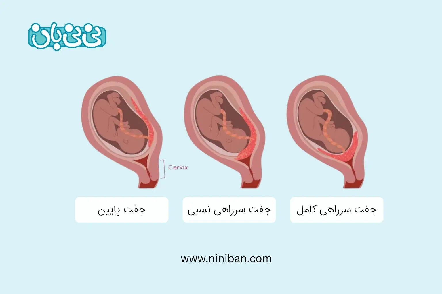پایین بودن جفت به چه معناست؟