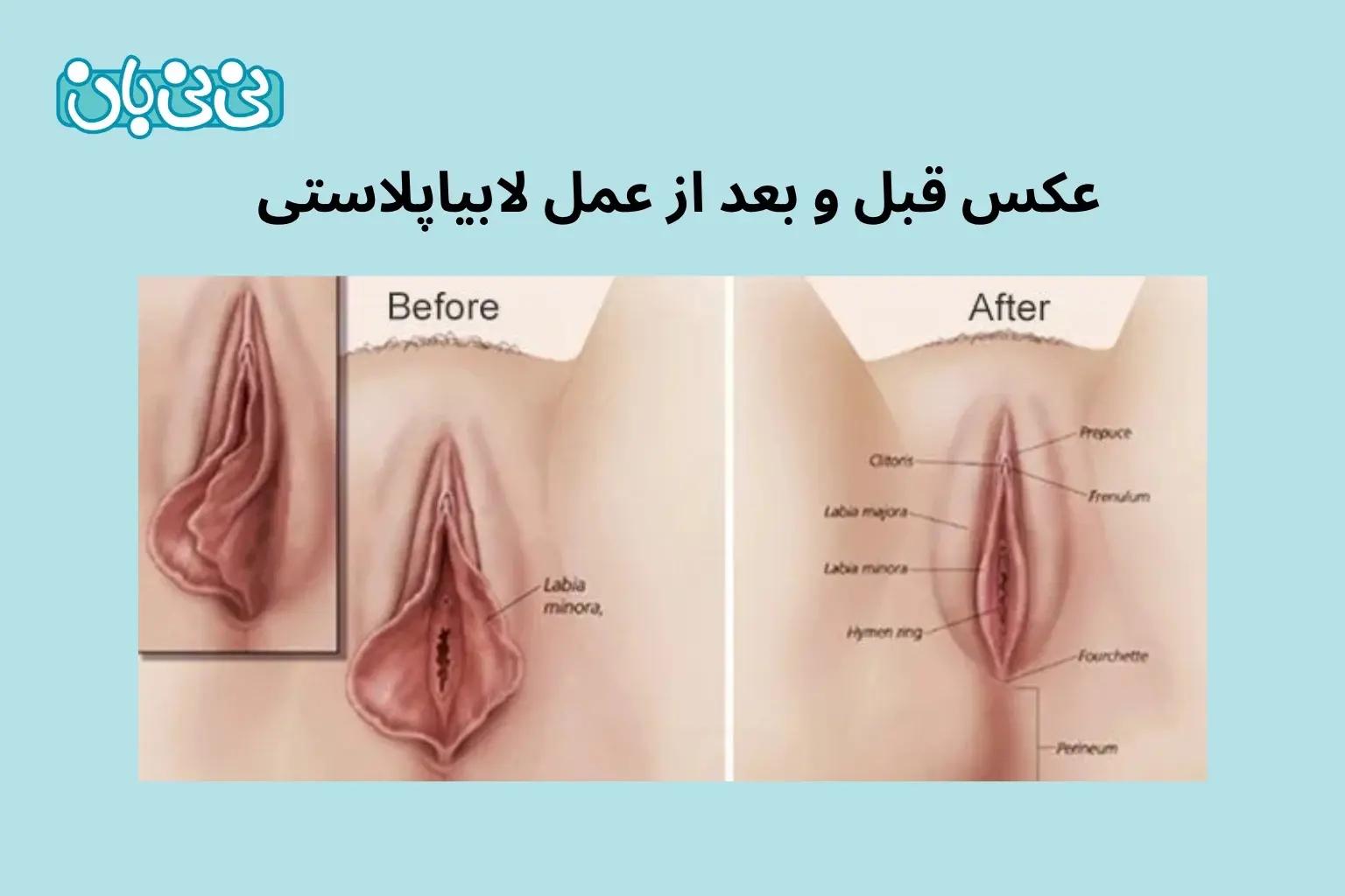 عکس قبل و بعد از عمل لابیاپلاستی 