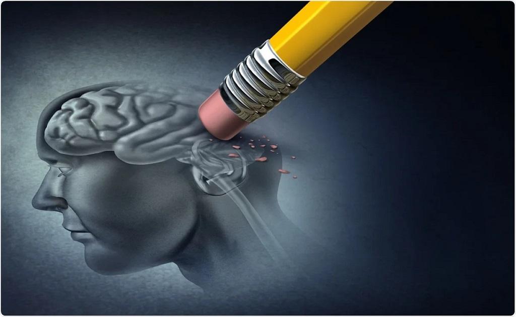آلزایمر 