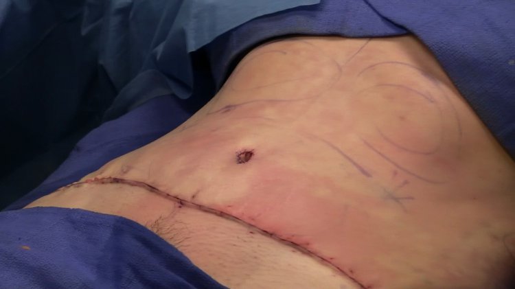 Abdominoplasty_completely_sutured.width-750