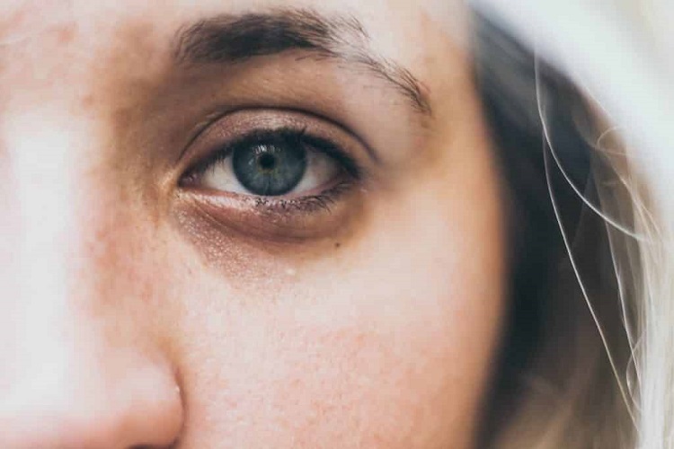 اندولیفت زیر چشم، یک درمان سرپایی و کم تهاجمی