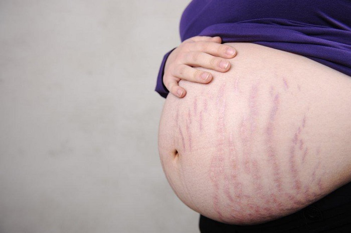 جلوگیری از ترک شکم در حاملگی چگونه است؟