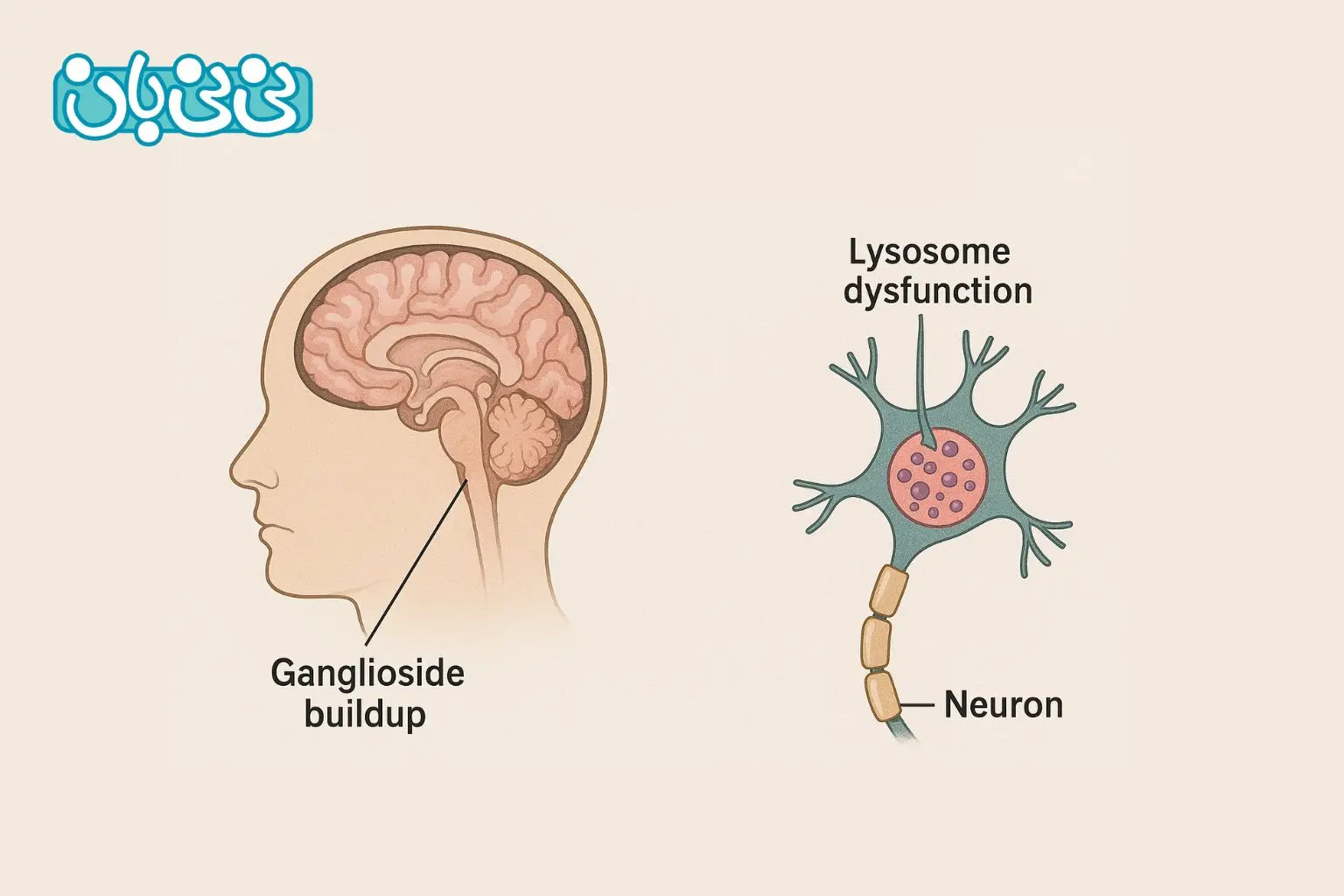 علت بیماری تای ساکس در کودکان چیست