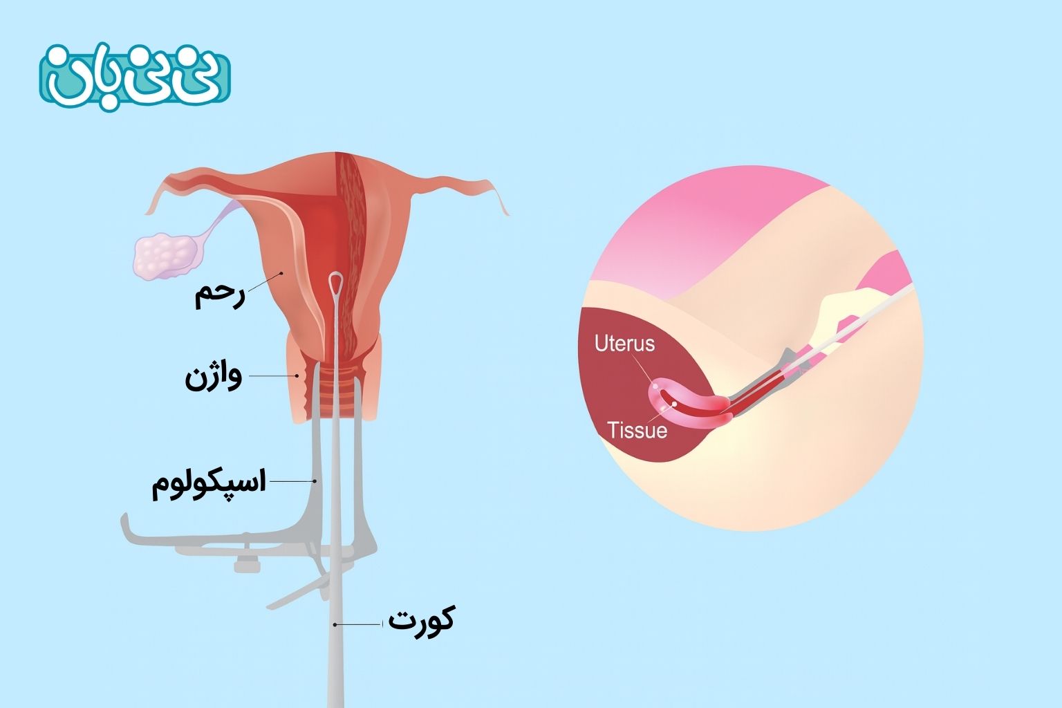کورتاژ چگونه انجام می_شود؟
